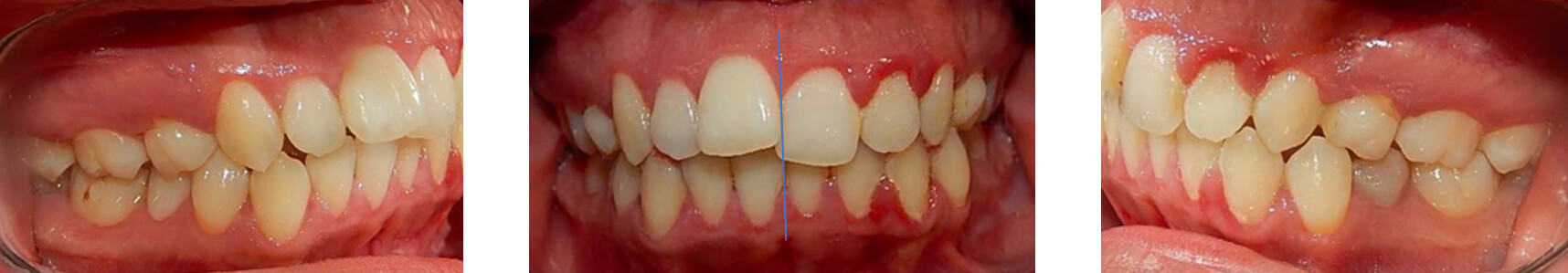 Fig. 3 lateral derecha,  frente intraoral  lateral izquierda