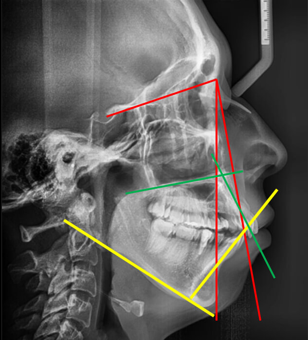 Fig. 4 lateral de cráneo