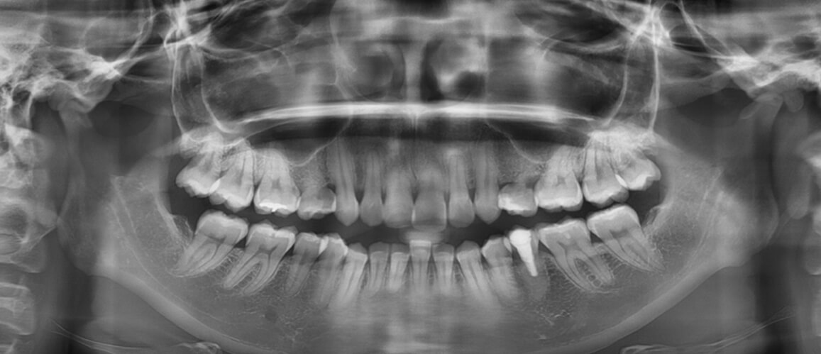 Fig. 5 radiografía panorámica