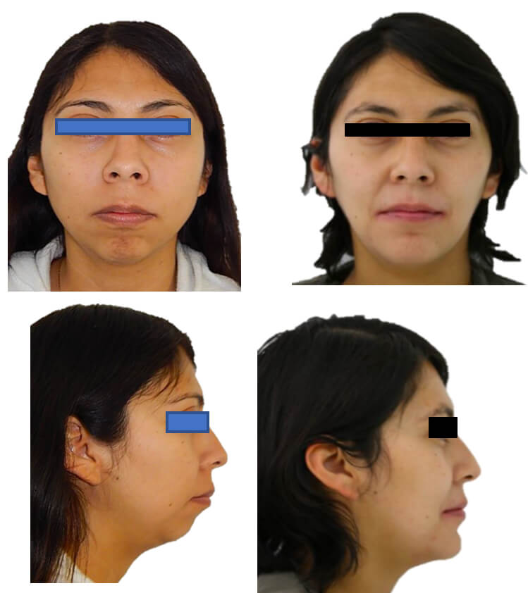 Fig.6 extraoral de frente inicio y perfil final.