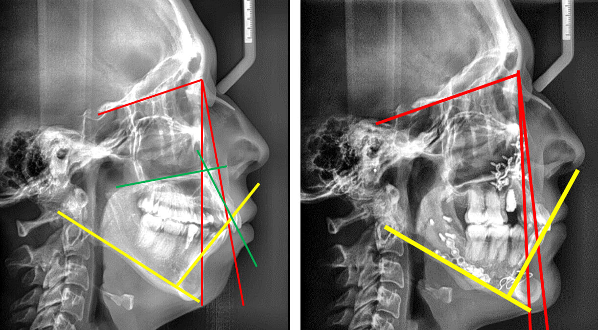 Fig. 8 radiografías laterales de cráneo comparación  inicio final