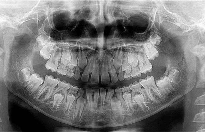 Figura 2. Radiografía panorámica inicial