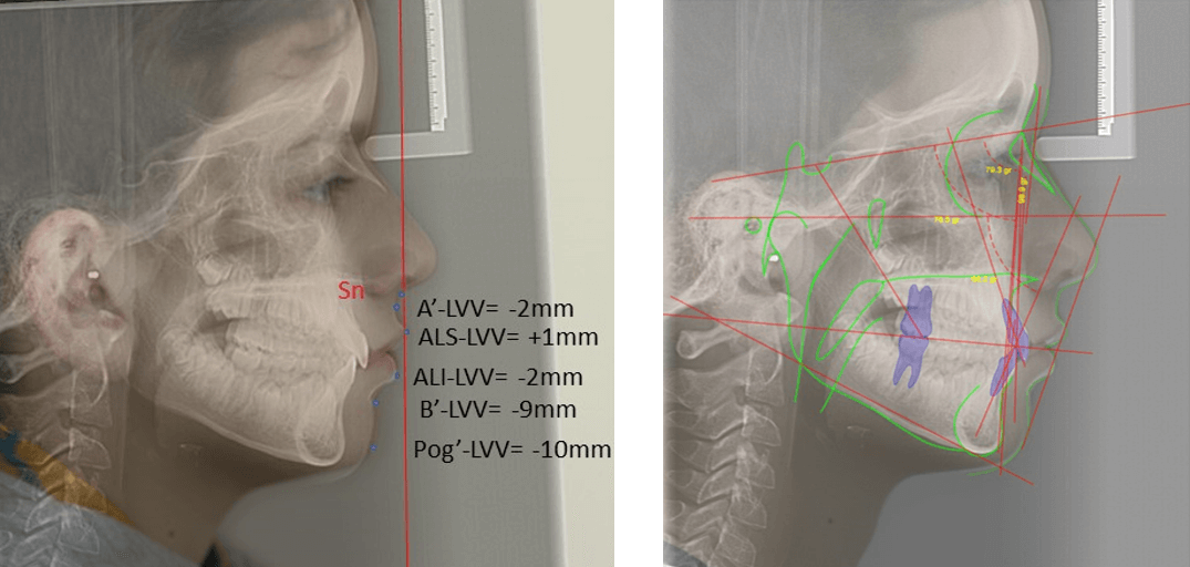 Figura 3. Cefalometría y análisis facial inicial 