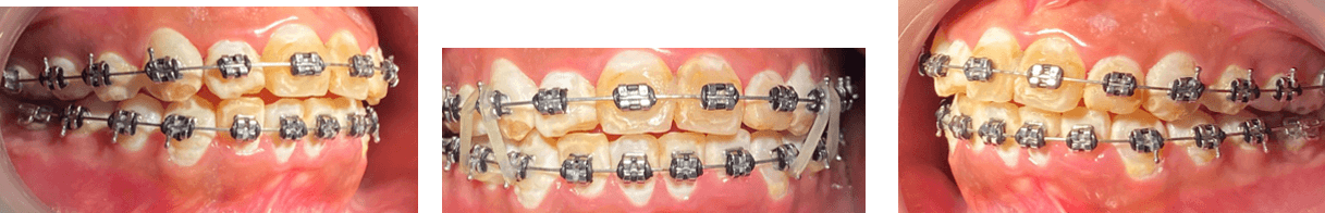 IMAGEN #10 Fotografias intraorales con las ligas en triangulo se logro cerrar un poco la morida abierta y acentamiento de caninos en clase II