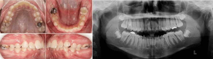 Figura 1. HMI. Fuente: Postgrado de Ortopedia Dentofacial y Ortodoncia UC
