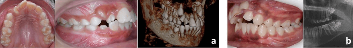 Figura 10. Supernumerarios. (a)  Vestibular a UD 12. (b) Vestibular a UD 27. Fuente: Postgrado de Ortopedia Dentofacial y Ortodoncia UC
