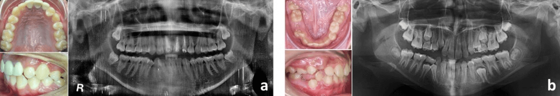 Figura 11.  Transposiciones. (a) UD 23-24. (b) UD 42-43. Fuente: Postgrado de Ortopedia Dentofacial y Ortodoncia UC