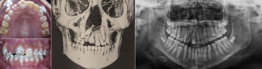 Figura 2. Fluorosis, supernumerario en área de UD 12 y mesiodens en zona de agenesia UD 11. Fuente: Postgrado de Ortopedia Dentofacial y Ortodoncia UC