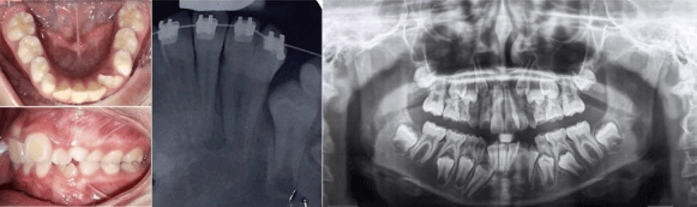Figura 3.  Fusión UD 32-33. Fuente: Postgrado de Ortopedia Dentofacial y Ortodoncia UC