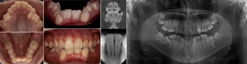 Fig 4. Geminación UD 32-31, fusión UD 41-42 y agenesia UD 15 y 25. Fuente: Postgrado de Ortopedia Dentofacial y Ortodoncia UC