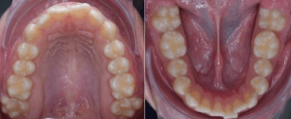 Figura 5.  Cúspides accesorias en segundos molares. Fuente: Postgrado de Ortopedia Dentofacial y Ortodoncia UC