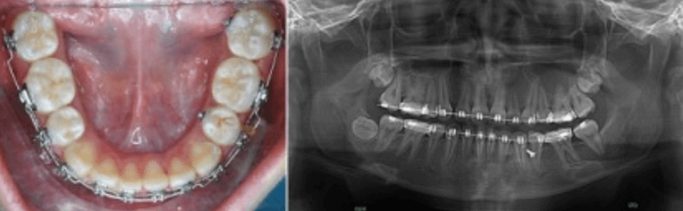 Figura 6. Taurodontismo en segundos molares. Fuente: Postgrado de Ortopedia Dentofacial y Ortodoncia UC