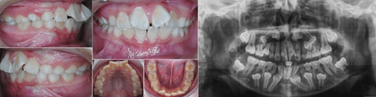 Figura 7. Macrodoncia de incisivos centrales y laterales superiores. Fuente: Postgrado de Ortopedia Dentofacial y Ortodoncia UC