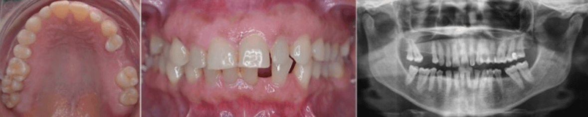 Figura 8. Microdoncia UD 12 y 22. Fuente: Postgrado de Ortopedia Dentofacial y Ortodoncia UC