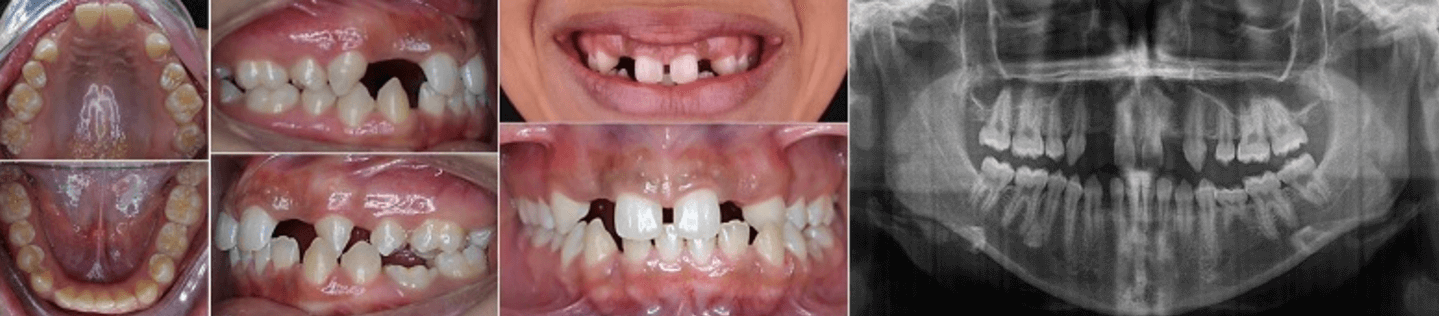 Figura 9. Agenesia UD 14, 12, 22, 24 y 35. Fuente: Postgrado de Ortopedia Dentofacial y Ortodoncia UC