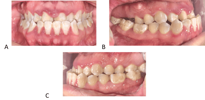 Figura 2.  Fotos Intraorales. A. Frontal. B y C. Laterales