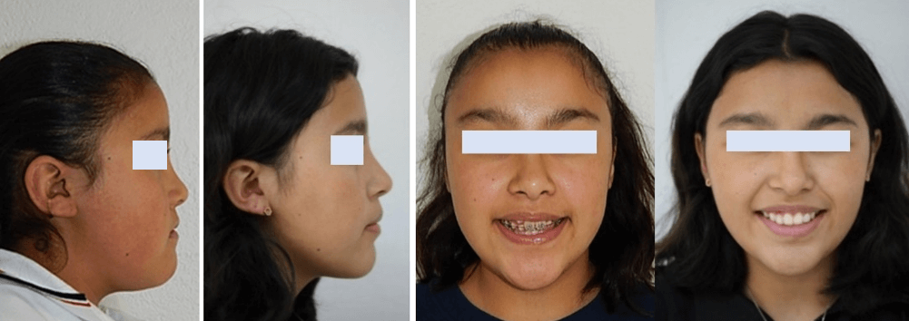 Fig. 10 perfil, sonrisa