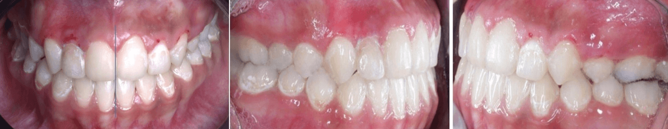 Fig. 13 intraorales frente, lateral derecha e izquierda