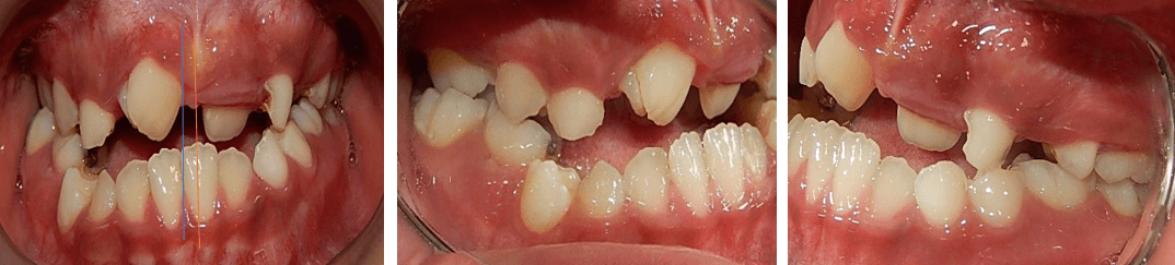 Fig.2  Intraoral frente,laterales: derecho izquierdo.