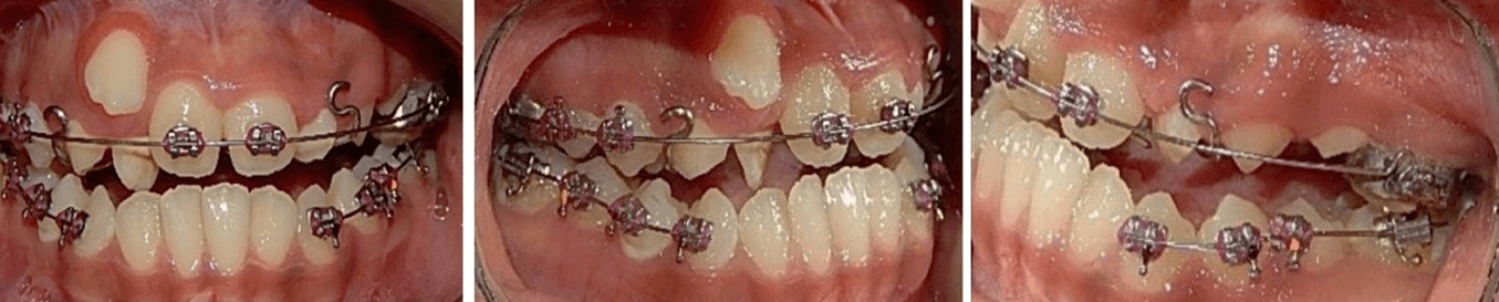 Fig. 6 Frente intraoral, lateral derecha, izquierda
