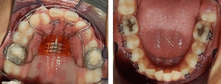 Fig. 7 Vista oclusal superior e inferior