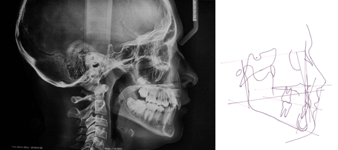 Imagen 1. Radiografía lateral y cefalometría inicial