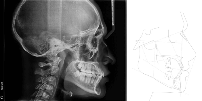 Imagen 2. Radiografía lateral y cefalometría final
