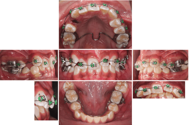 Imagen 6. Colocación de aparatología