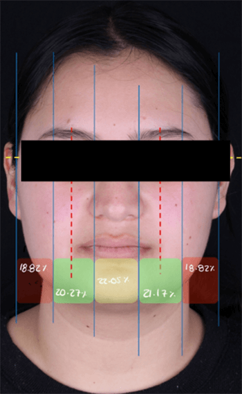 Figura 1. Análisis de quintos.