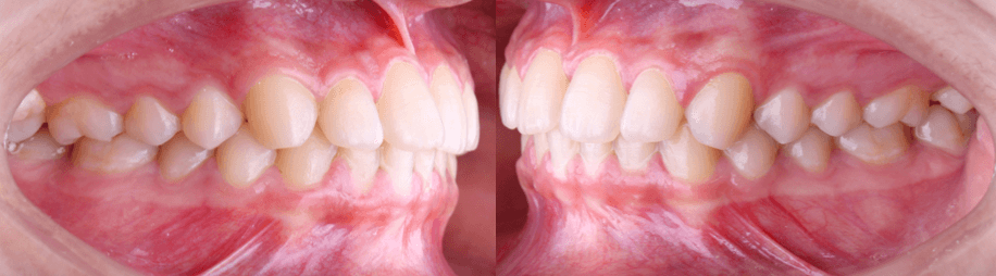 Figura 4. Fotografias intraorales derecha e izquierda.