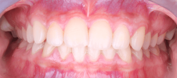 Figura 5. Fotografia intraoral de frente.