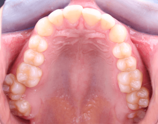 Figura 6. Fotografía oclusal superior.