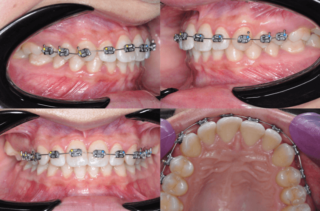Figura 9. Primera colocación.