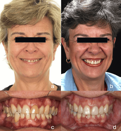 Tabla 2. – Análisis cefalométrico comparativo inicial y final.