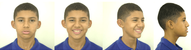 Fotografías Extraorales Iniciales