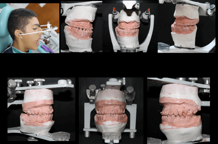 Montaje en Articulador Semiajustable y Cirugía de Modelo