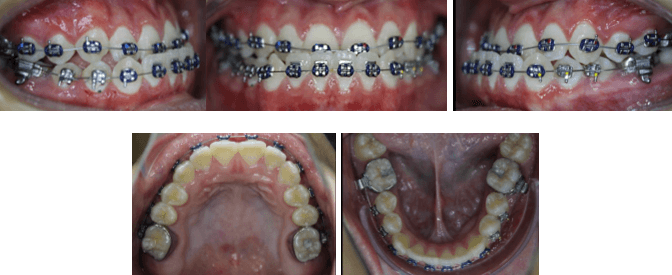 Fotografías Iniciales de Inicio de Tratamiento de Ortodoncia Prequirúrgica