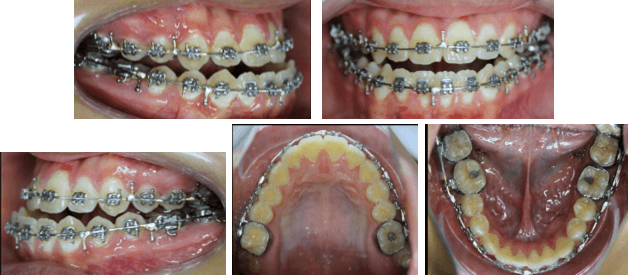 Fotografías Intraorales Pre Quirúrgicas