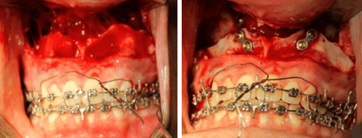 Osteotomía Le Fort I y Genioplastia