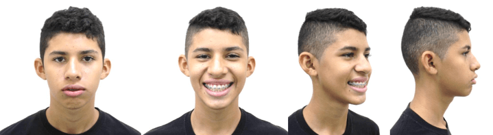 Fotografías Post Quirúrgicas Extraorales