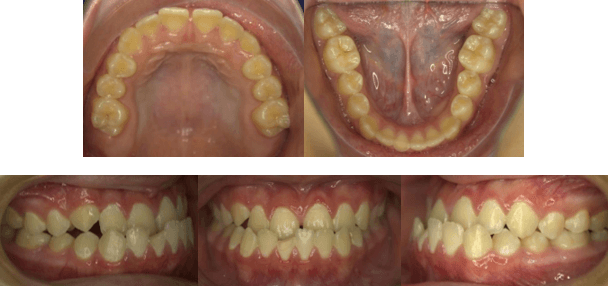 Fotografías Intraorales Iniciales