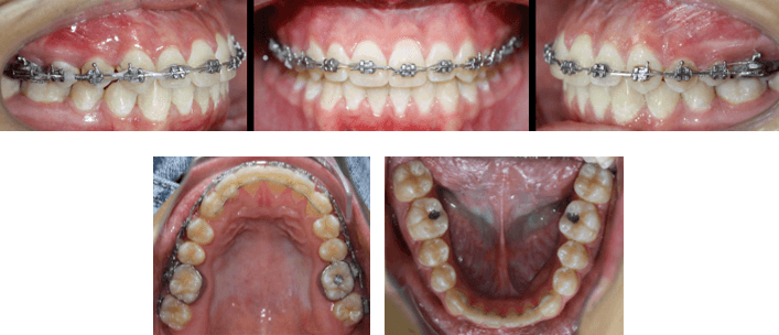 Fotografías Post Quirúrgicas Intraorales