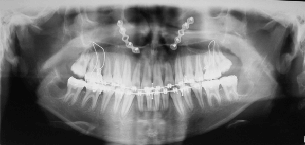 Radiografía Panorámica Final