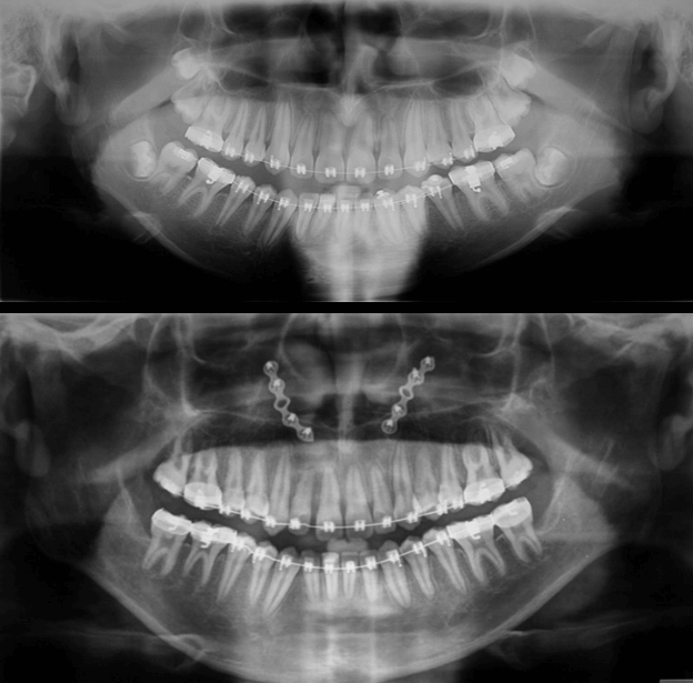 Radiografía Panorámica Comparativa