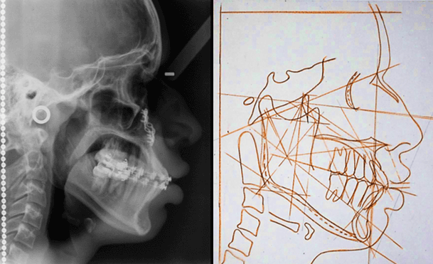 Radiografía Cefálica Lateral Final