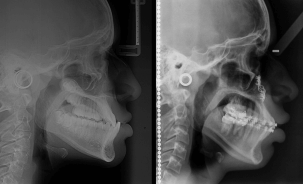 Radiografía Cefálica Lateral Comparativa
