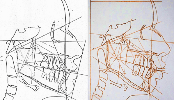 Cefalograma Lateral Comparativa