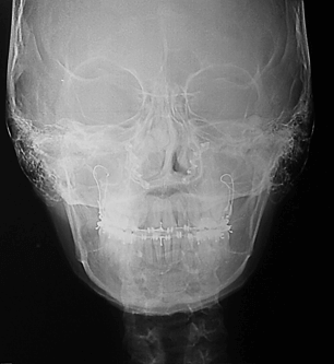 Radiografía Postero Anterior Final