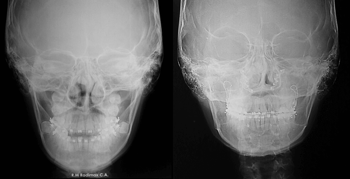 Radiografía Postero Anterior Comparativa