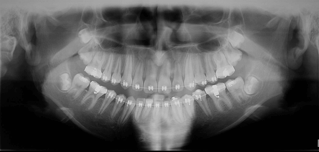 Radiografía Panorámica Inicial